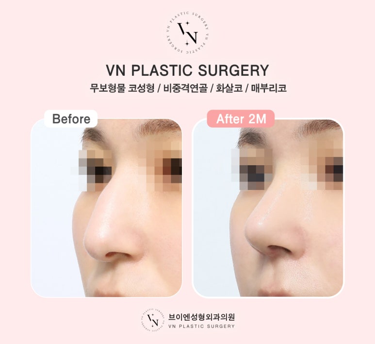 VN Plastic Surgery One-Day Implant-Free Rhinoplasty, Fast Recovery and Safety at the Same Time! image 5