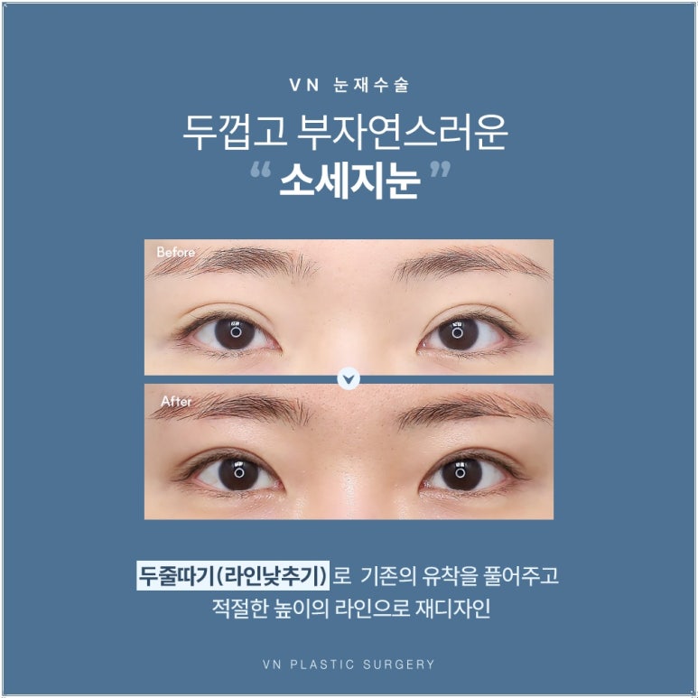 강남눈재수술, 원인이 다르면 방법도 달라집니다 관련 이미지 3