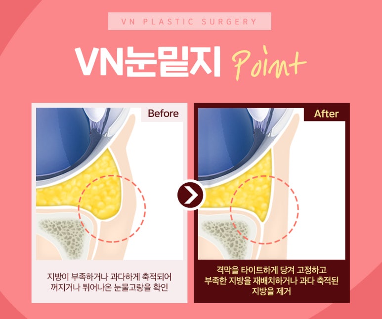 Lower Eyelid Fat Repositioning? Stop Hearing That You Look Tired Because of Dark Circles!🤚 image 2