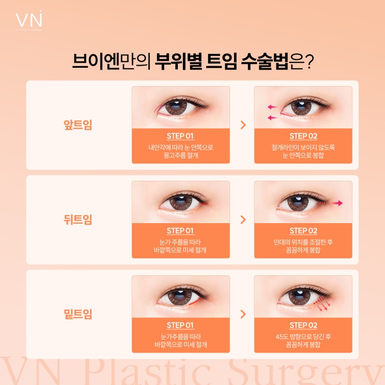 답답해 보이는 눈, 트임 성형으로 개선할 수 있을까? 관련 이미지 4