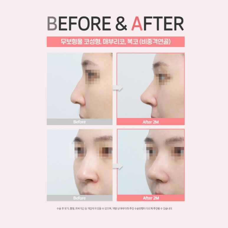 코성형수술 전이라면 클릭🖱 (feat. 수술재료 모아보기) 관련 이미지 10