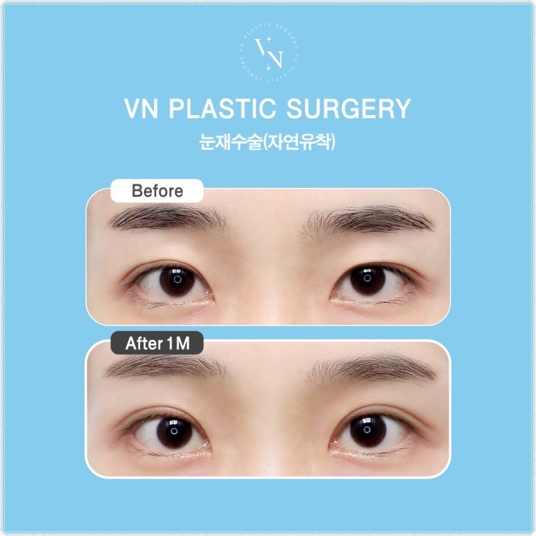 Why Extreme Eye Revision Surgery Is Difficult for Hooded Eyes, Asymmetric Eyes, and Double Fold Correction [VN Plastic Surgery, Gangnam] image 6