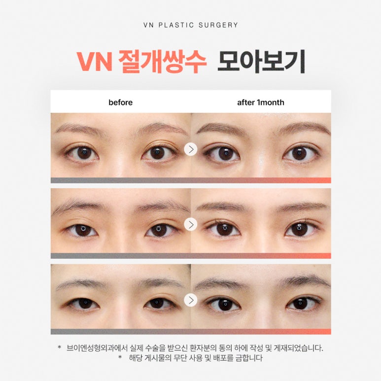 [Gangnam/Sinnonhyeon VN Plastic Surgery] Post-College Entrance Exam Double Eyelids Surgery Is Timed Perfectly Now! image 3