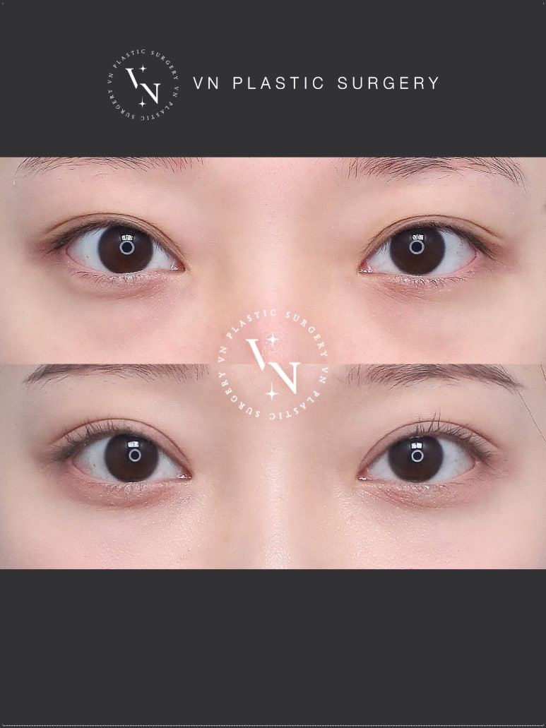 VN Plastic Surgery Lower Blepharoplasty vs. Lower Eyelid Fat Repositioning: Which Is Right for Me? image 5