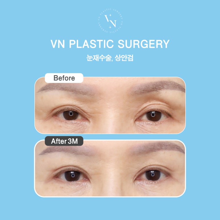 How to Effectively Address Drooping Eyelids with Upper Blepharoplasty, VN Plastic Surgery image 5