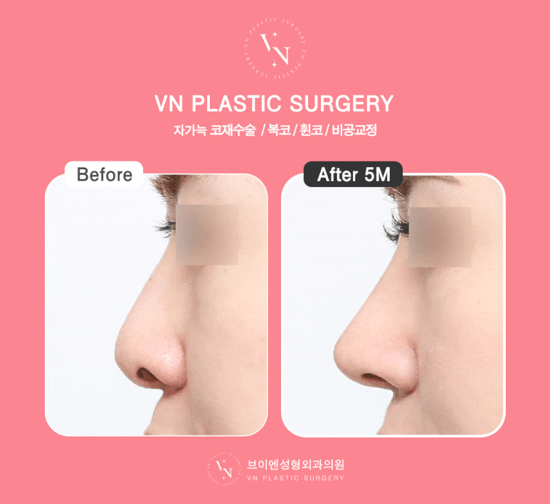 [Gangnam/Sinnonhyeon VN Plastic Surgery] Autologous Rib Cartilage Surgery: Rhinoplasty Tips to Reduce Pain and Recovery Concerns image 4