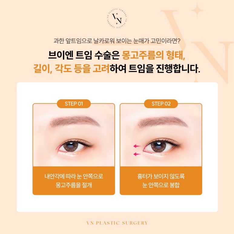 VN Plastic Surgery: If You’re Worried That Your Expression Looks Harsh After Eye Surgery image 5
