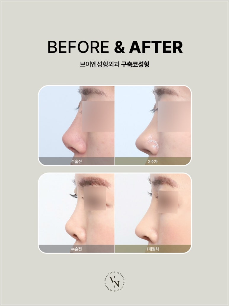 When Should Contracture Nose Revision Surgery Be Done? From Causes to Solutions (VN Plastic Surgery) image 2