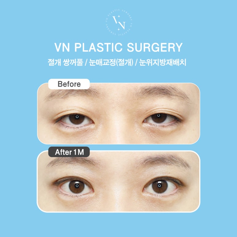 VN Plastic Surgery Real Model Recruitment & Application Method image 6