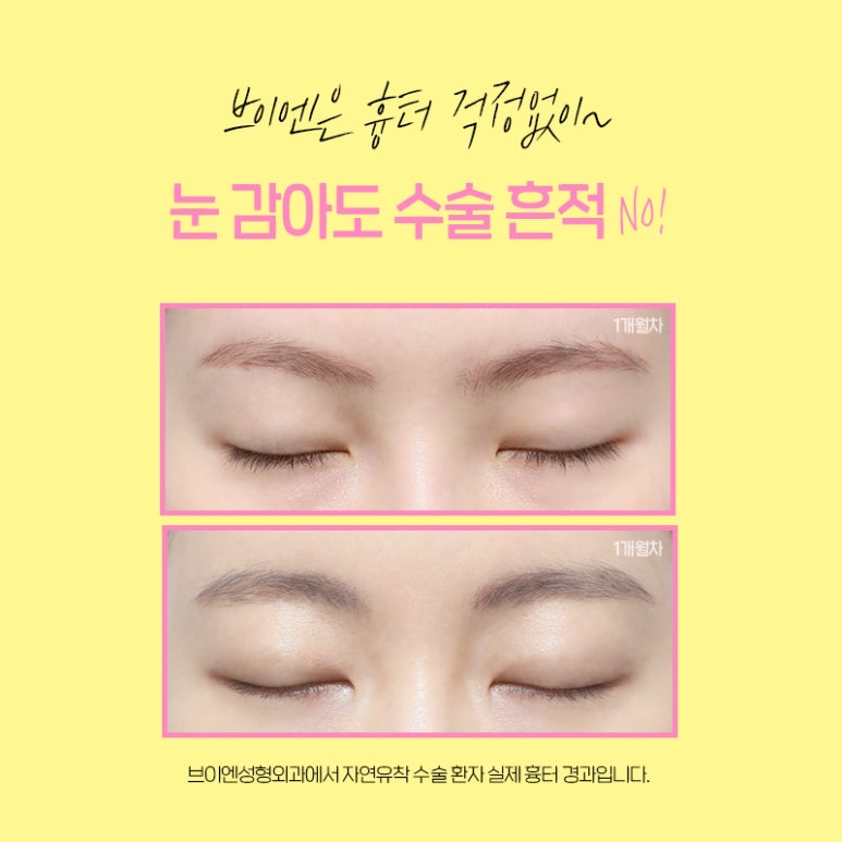 인라인? 아웃라인? 쌍꺼풀수술라인 종류 알아보기 (+연예인 쌍꺼풀) 관련 이미지 7