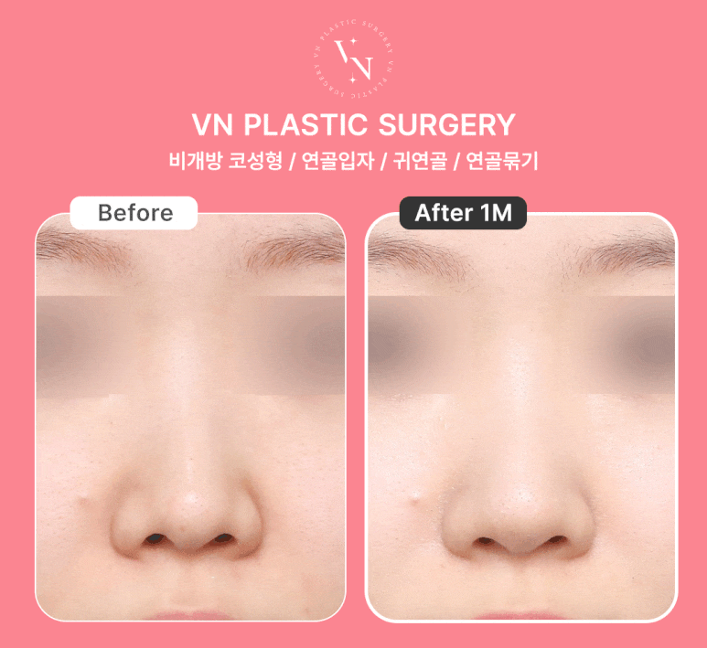 Closed Rhinoplasty Using Autologous Cartilage, Naturally Completed with VN Plastic Surgery’s ShashaKo ✨ image 6