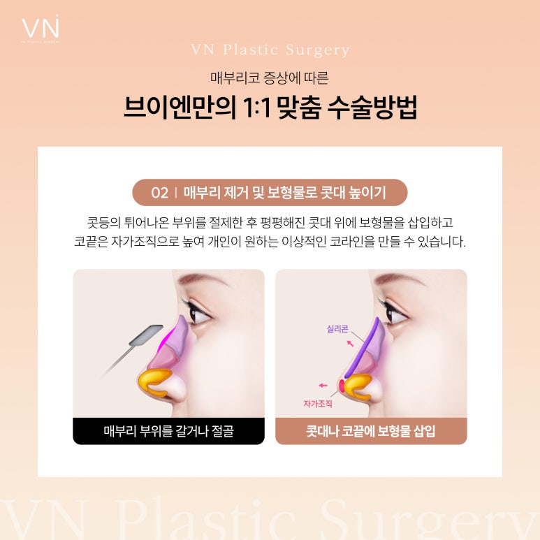 The Importance of Personalized Surgery for Hump Nose Surgery image 4