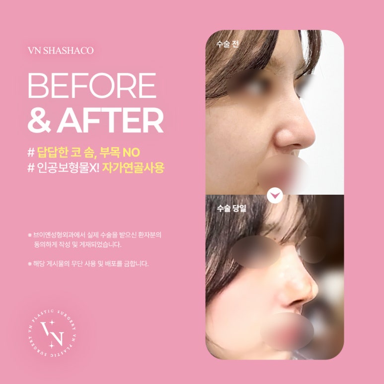 Thinking About Non-Open Nose Surgery? Find the Answer with ShashaKo at VN Plastic Surgery image 3