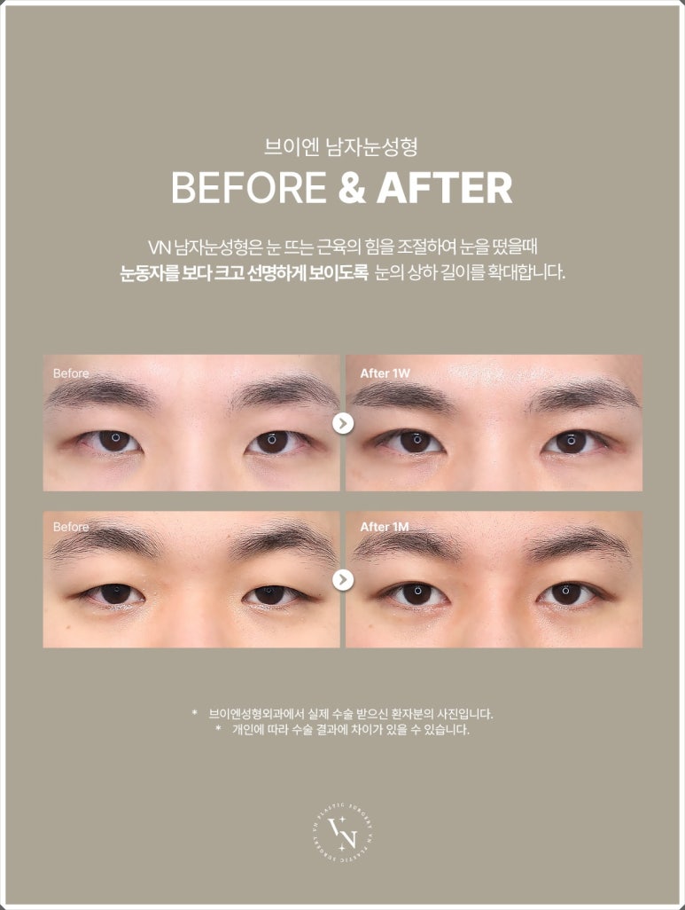 Male Eye Surgery: The Difference in Details That Create a Natural Eye Shape image 3