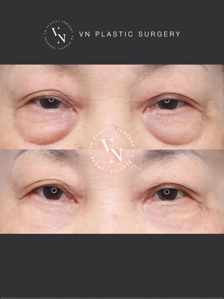 VN Plastic Surgery Lower Blepharoplasty vs. Lower Eyelid Fat Repositioning: Which Is Right for Me? image 4