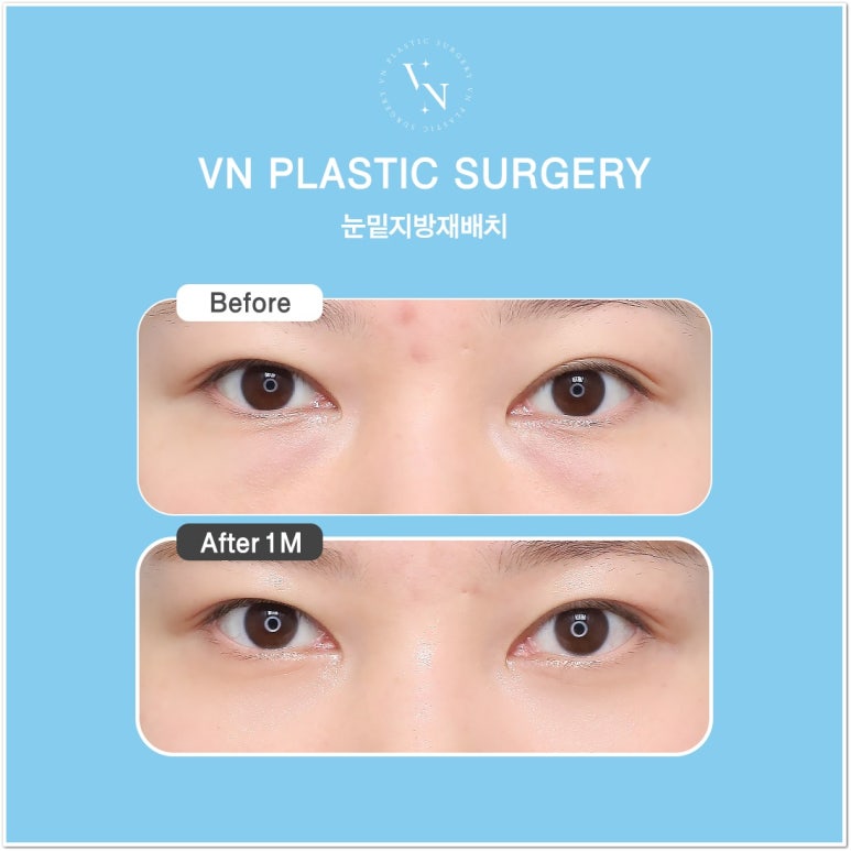 Best Place for Lower Eyelid Fat Repositioning: Should You Always Remove Lower Eyelid Fat? image 5