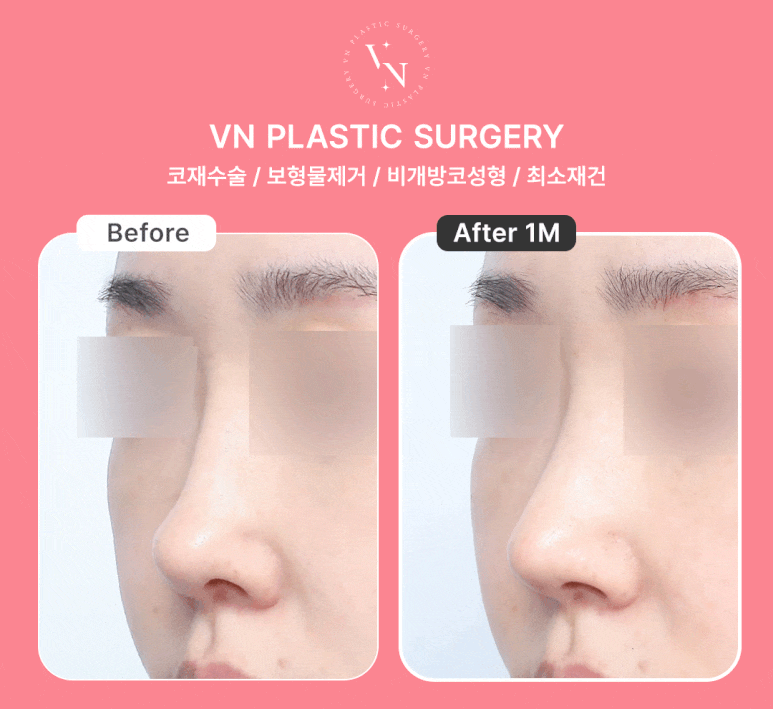 Restoring a Natural Look with Closed Nasal Implant Removal, VN Plastic Surgery image 5