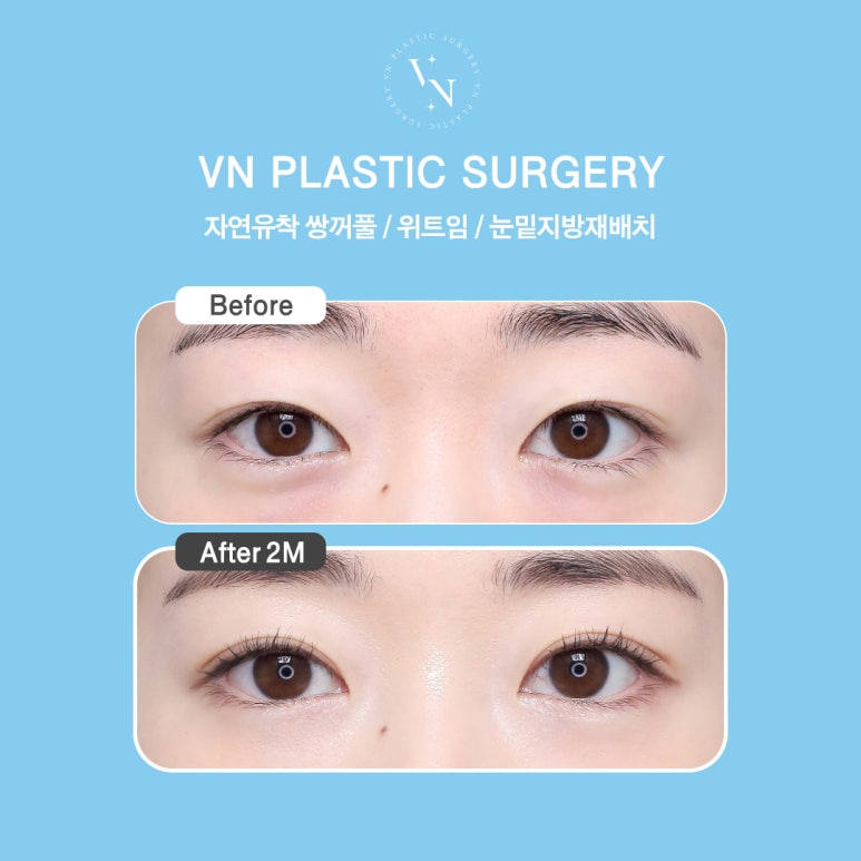 Shinnonhyeon Plastic Surgery Eye Surgery Trend: Why the In-Out Line Is Getting Attention image 4