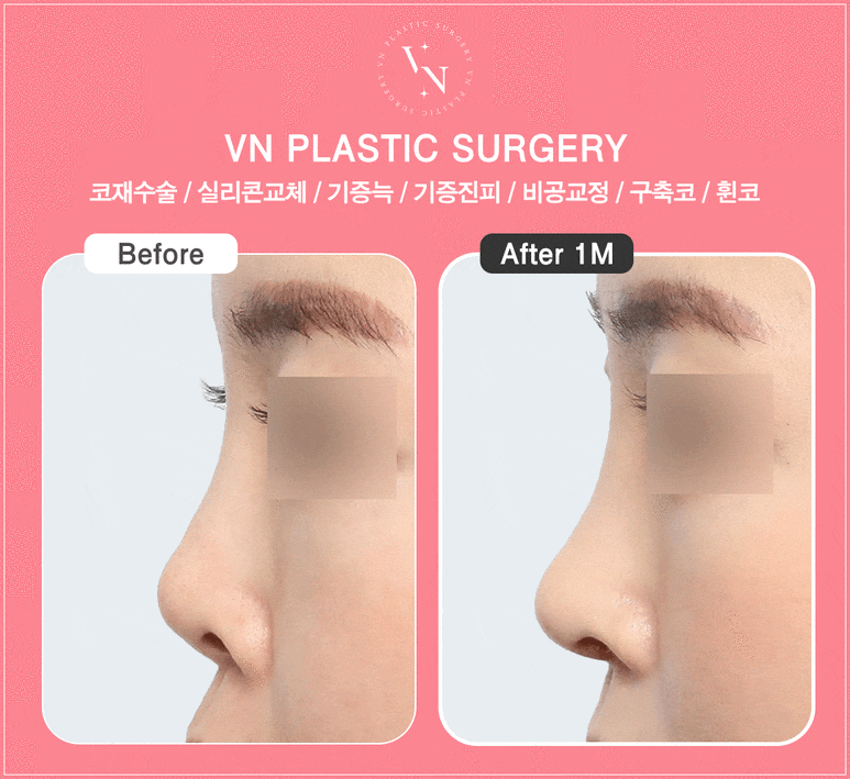 When Should Contracture Nose Revision Surgery Be Done? From Causes to Solutions (VN Plastic Surgery) image 5