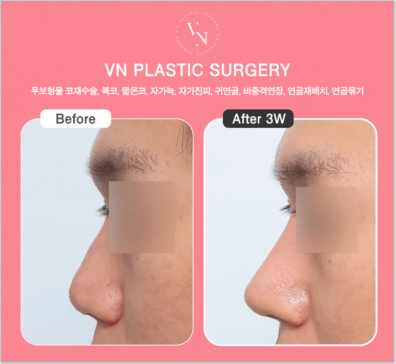 무보형물코성형 장단점, 무조건 보형물이 없는 게 좋을까? | 브이엔성형외과 관련 이미지 8