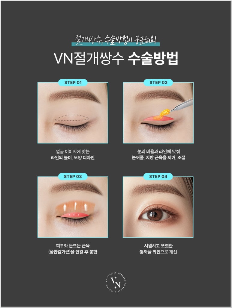 Double Eyelid Incision Surgery Review｜Do I Need Incisional Double Eyelid Surgery? image 2