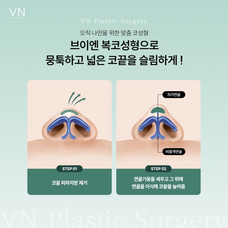 복코 수술, 일반적인 코수술과는 어떤 차이가 있을까? 관련 이미지 3