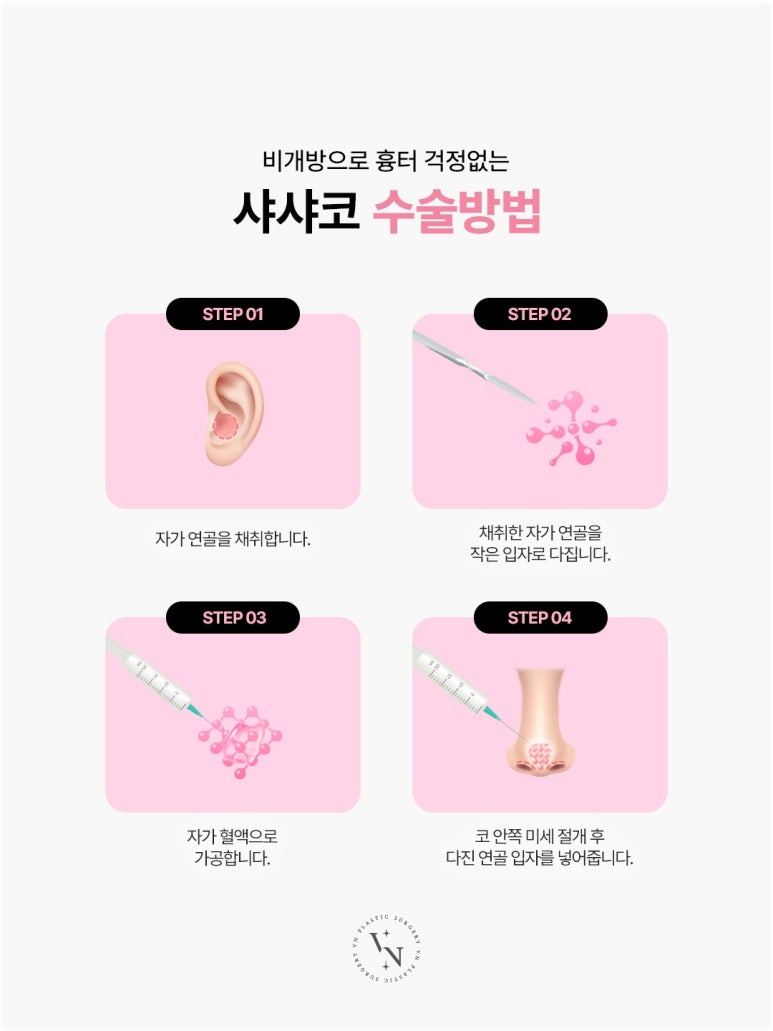 Cartilage Particle Rhinoplasty (Shasha Nose): Why Finely Mince the Cartilage? image 2