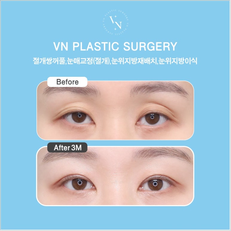 Double Eyelid Incision Surgery Review｜Do I Need Incisional Double Eyelid Surgery? image 6