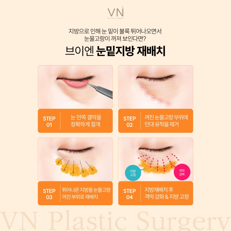 눈밑수술에 대해 알아보자! (ft. 눈밑지방재배치,눈밑지방제거) 관련 이미지 4