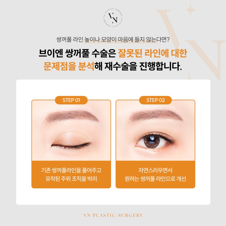 VN Plastic Surgery: If You’re Worried That Your Expression Looks Harsh After Eye Surgery image 4