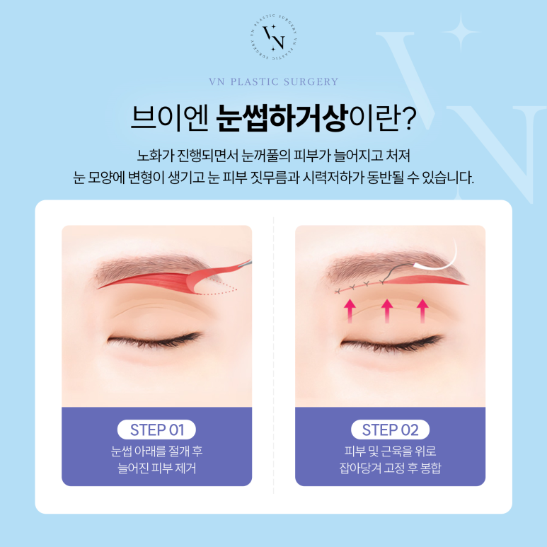 VN Plastic Surgery: What Is the Solution for Drooping Eyelids? image 3