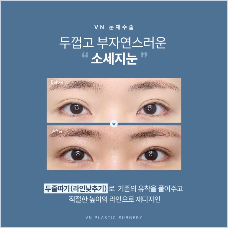 눈재수술성형외과, 원인부터 다르게 봐야 하는 이유 관련 이미지 3
