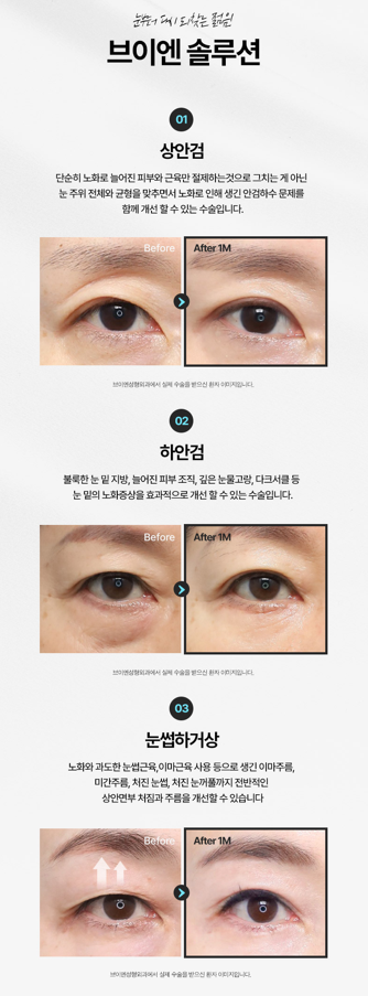 눈밑 처짐을 개선하는 신논현 브이엔성형외과 하안검수술 관련 이미지 6