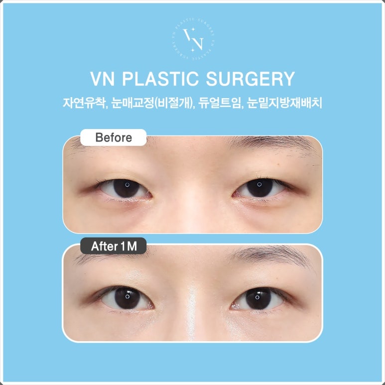 Male Eye Surgery: The Difference in Details That Create a Natural Eye Shape image 9