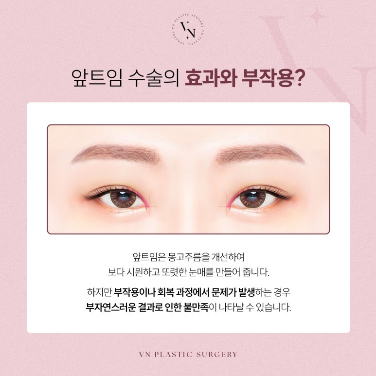 앞트임 복원 필요한 경우는? 관련 이미지 2