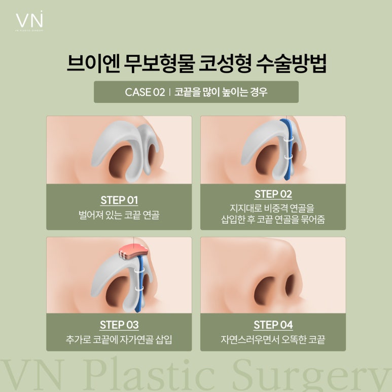 If you’re afraid of complications from nasal implants, implant-free rhinoplasty image 4