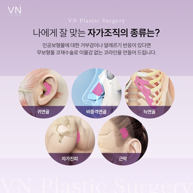 Can revision rhinoplasty be done without implants? image 3