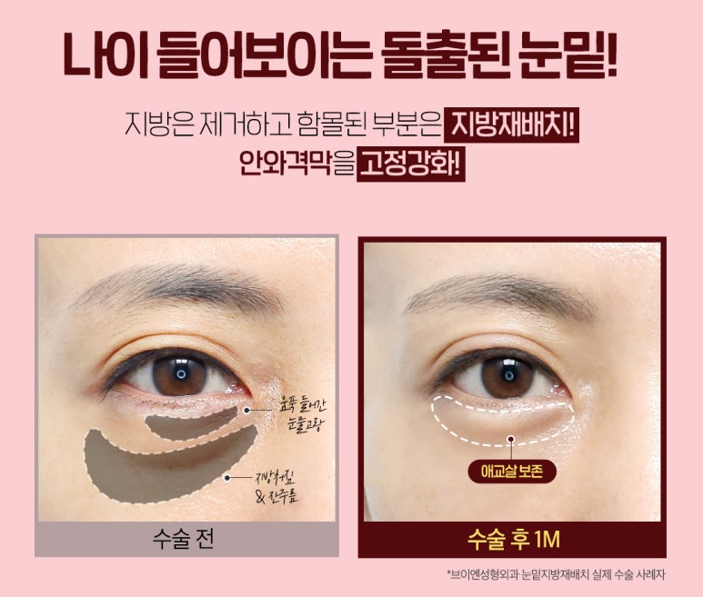Lower Eyelid Fat Repositioning? Stop Hearing That You Look Tired Because of Dark Circles!🤚 image 6