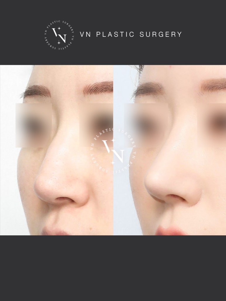 [Sinnonhyeon Plastic Surgery] If Your Hump Nose Is Stressing You Out, Be Sure to Read This image 5