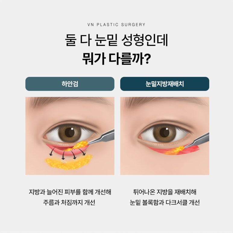 VN Plastic Surgery Lower Blepharoplasty vs. Lower Eyelid Fat Repositioning: Which Is Right for Me? image 2