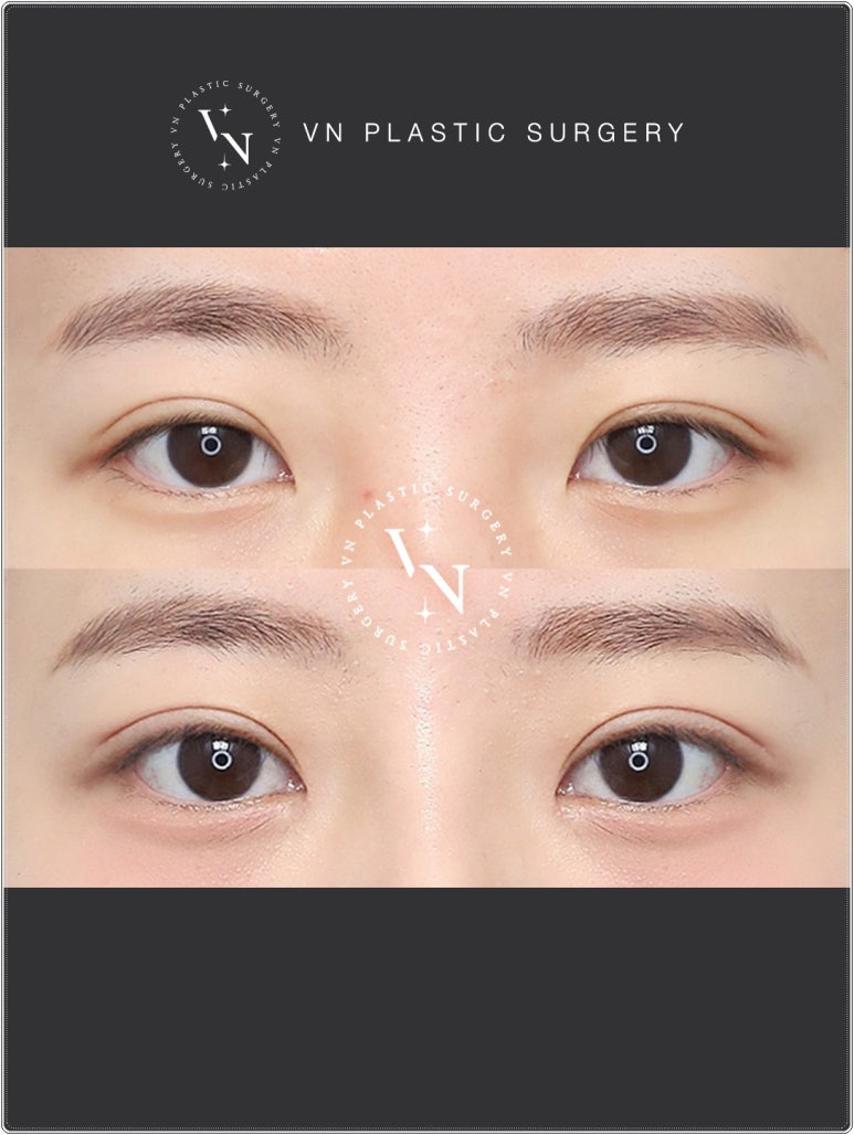 VN Plastic Surgery: If the Inline Looked Too Constricted and the Outline Felt Too Dramatic image 4