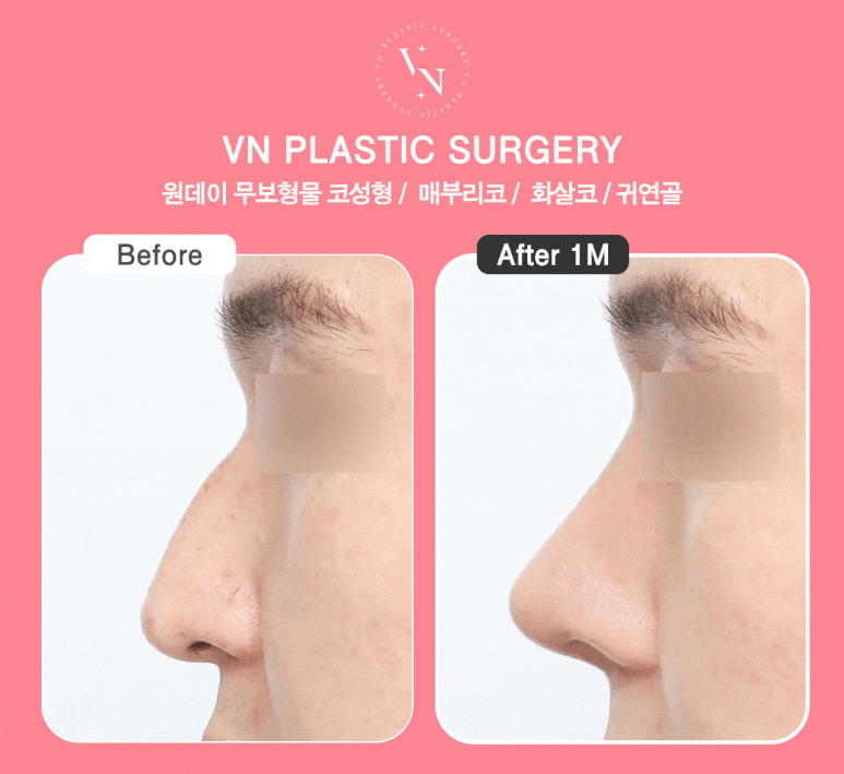 [Arrow Nose Correction in Sinnonhyeon/Gangnam] How to Fix a Nose That Looks Long and Change Your Impression ｜ VN Plastic Surgery image 6