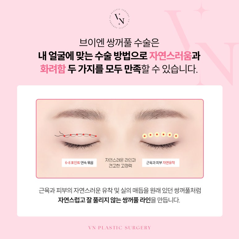 Vn Plastic Surgery: What Is the Best Way to Avoid Failure in Your First Double Eyelid Surgery? image 4