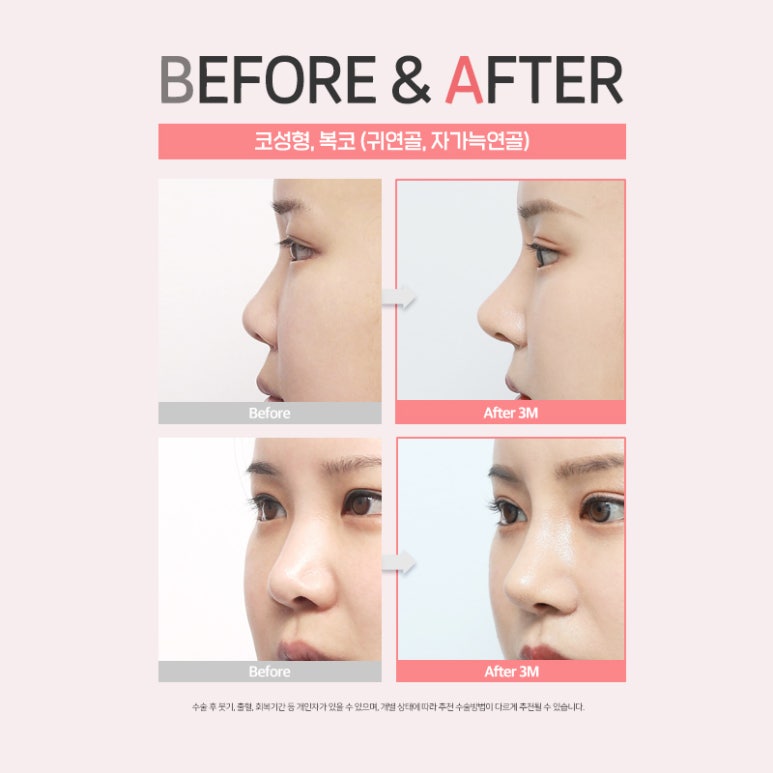 코성형수술 전이라면 클릭🖱 (feat. 수술재료 모아보기) 관련 이미지 8