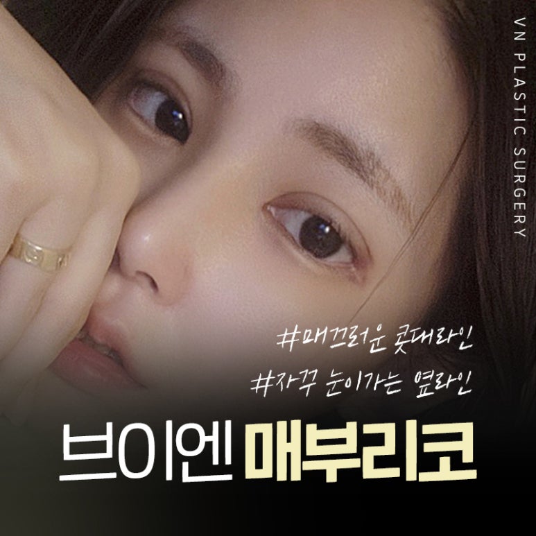 브이엔성형외과 제공｜매부리코교정 방법은? 관련 이미지 3