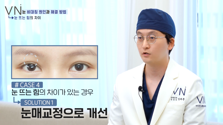 첫쌍꺼풀수술 전, 비대칭 짝눈의 원인과 해결법을 알아보자! 😀 관련 이미지 7