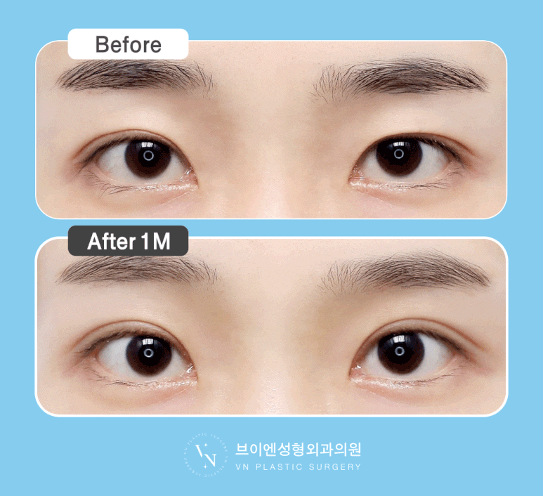 [Sinnonhyeon Plastic Surgery] Before Your First Double Eyelid Surgery, Be Sure to Check This! Do I Have Sunken Eyes or Protruding Eyes? image 3