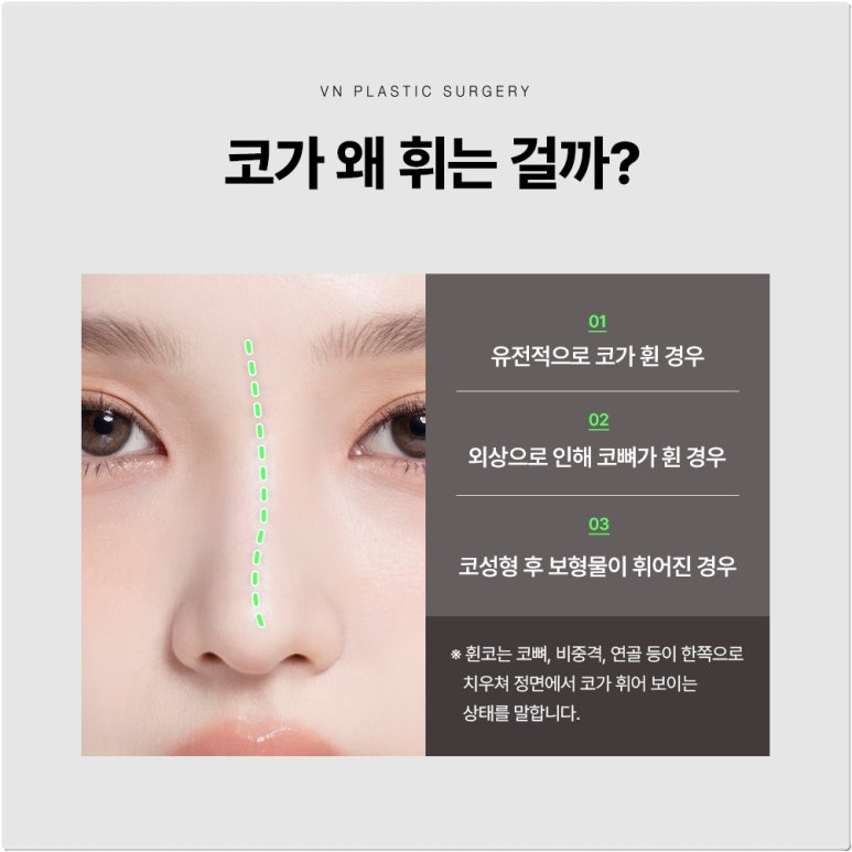 [VN Plastic Surgery] The Key to Correcting a Crooked Nose Is Identifying the Cause: Congenital or Acquired? image 4