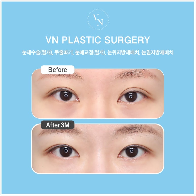 Best Place for Lower Eyelid Fat Repositioning: Should You Always Remove Lower Eyelid Fat? image 8