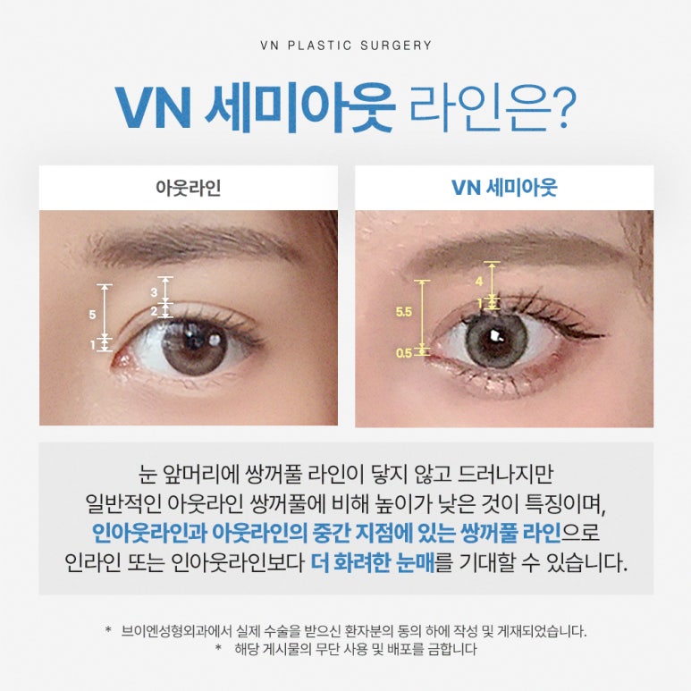 [강남/신논현 브이엔성형외과] 수험생쌍꺼풀수술, 자연스럽게 예뻐지는 가장 확실한 방법 관련 이미지 2